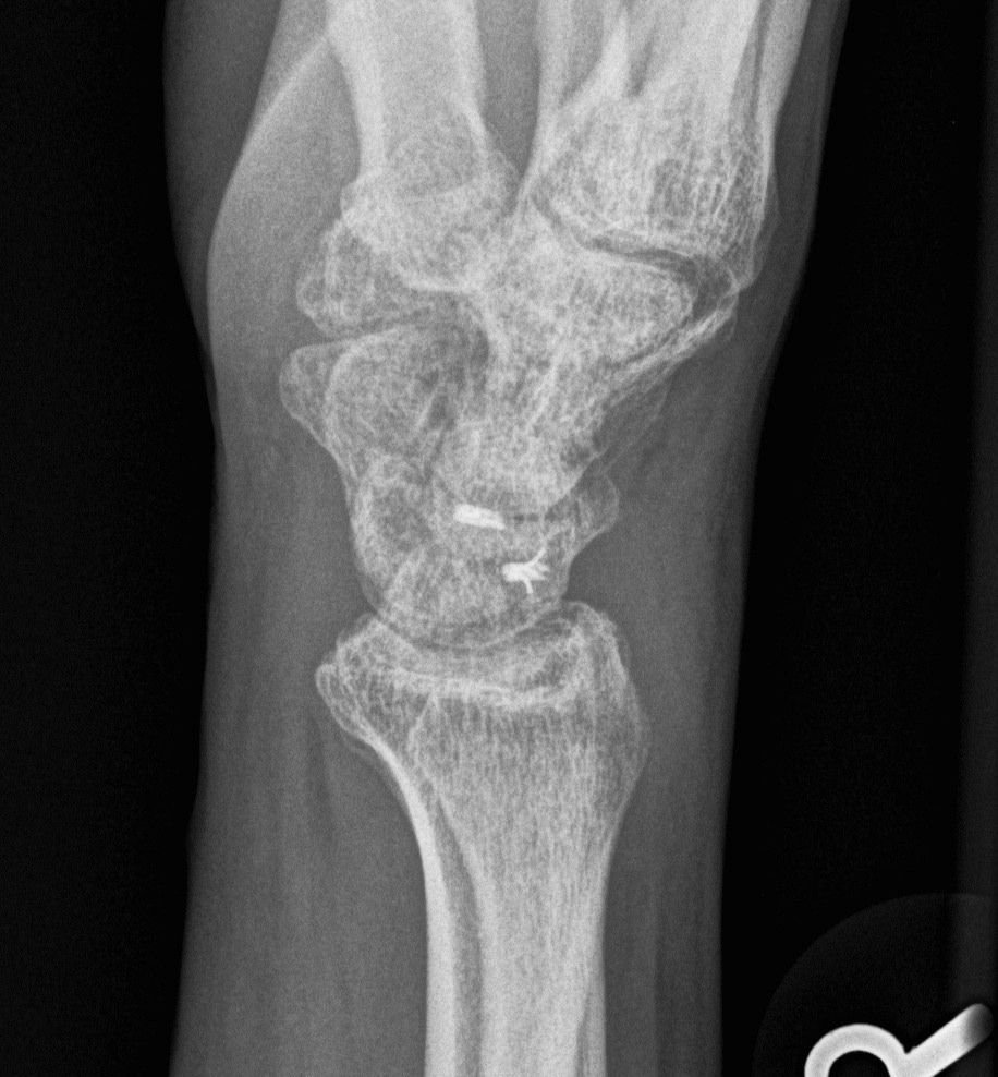 Scapholunate Ligament Reconstruction Lateral